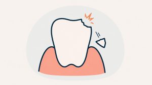 角が欠けて破片が飛んだ前歯のイラスト（歯の破折）
