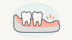 抜歯後のドライソケットのイラスト