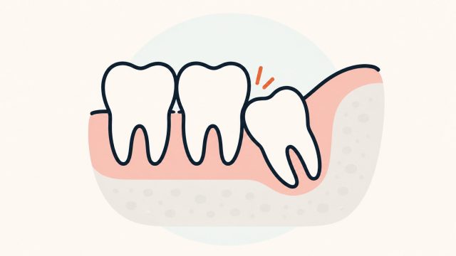 斜めに生えて隣の歯を押す親知らず（第三大臼歯）の断面図