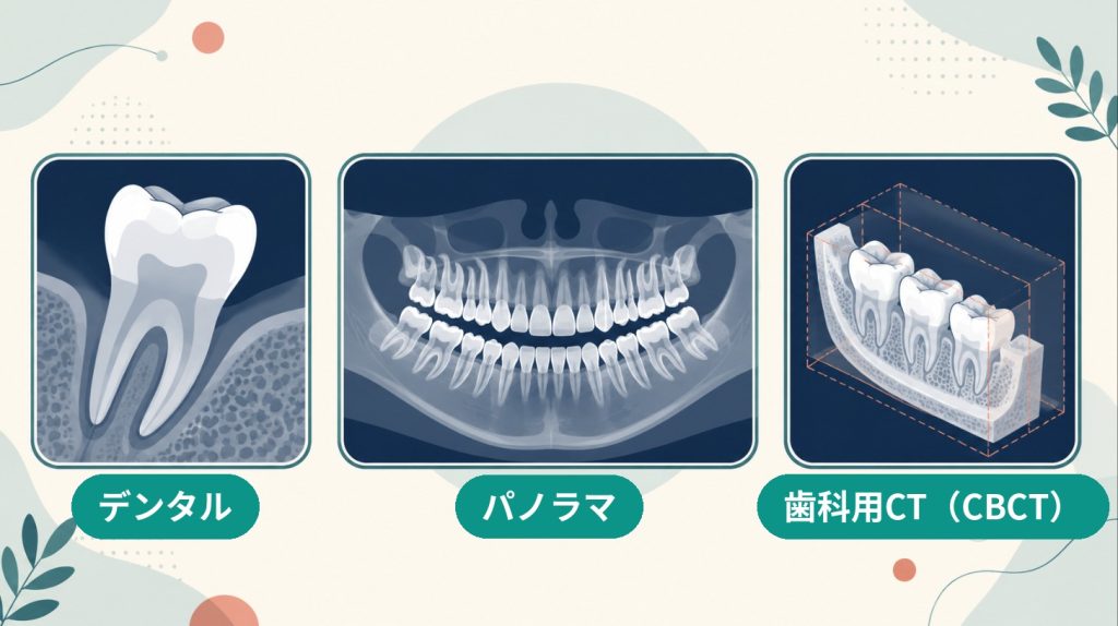 歯のレントゲン3種類のイメージ。左＝デンタルで1本の歯を拡大、中央＝パノラマで上下の歯全体、右＝歯科用CT（CBCT）で立体的にあごの一部を表したイラスト。