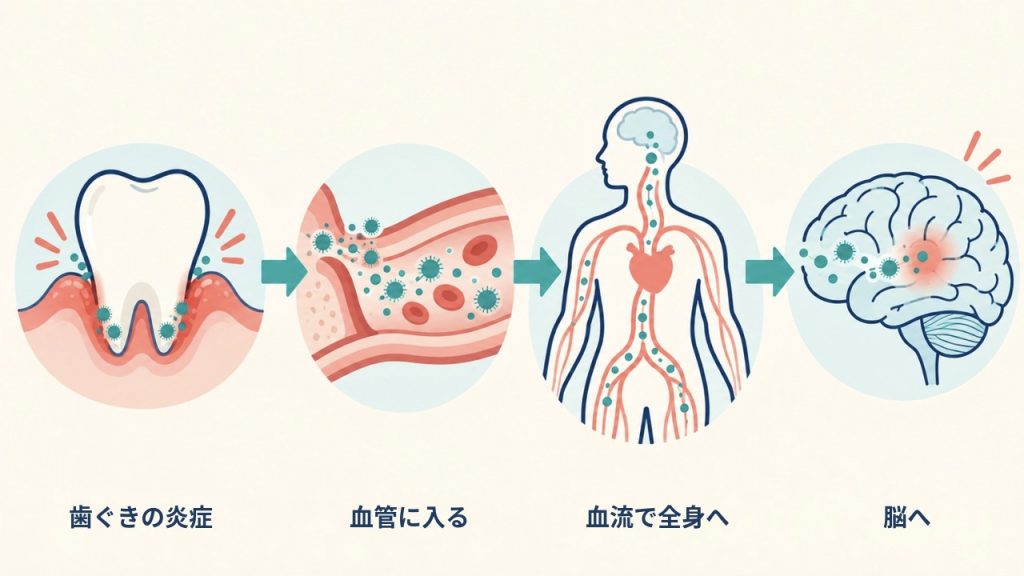 歯ぐきの炎症から菌や炎症のもとが血管に入り、血流で全身をめぐって脳へ届くまでを示した4ステップの概念図