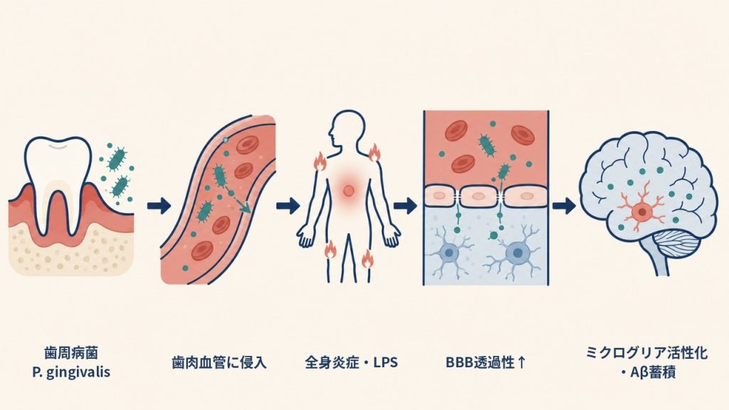 歯周病菌P. gingivalisが歯肉の血管から全身をめぐり、血液脳関門の内皮細胞間隙を血液側から脳側へ一方向に通過してミクログリア活性化とアミロイドβ蓄積に至る口腔–脳軸の作業仮説フロー図