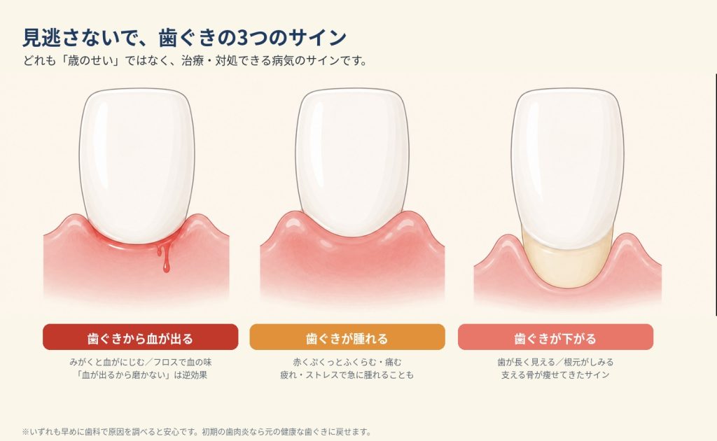 歯ぐきから血が出る・腫れる・下がるの3つのサインと原因を示した図解