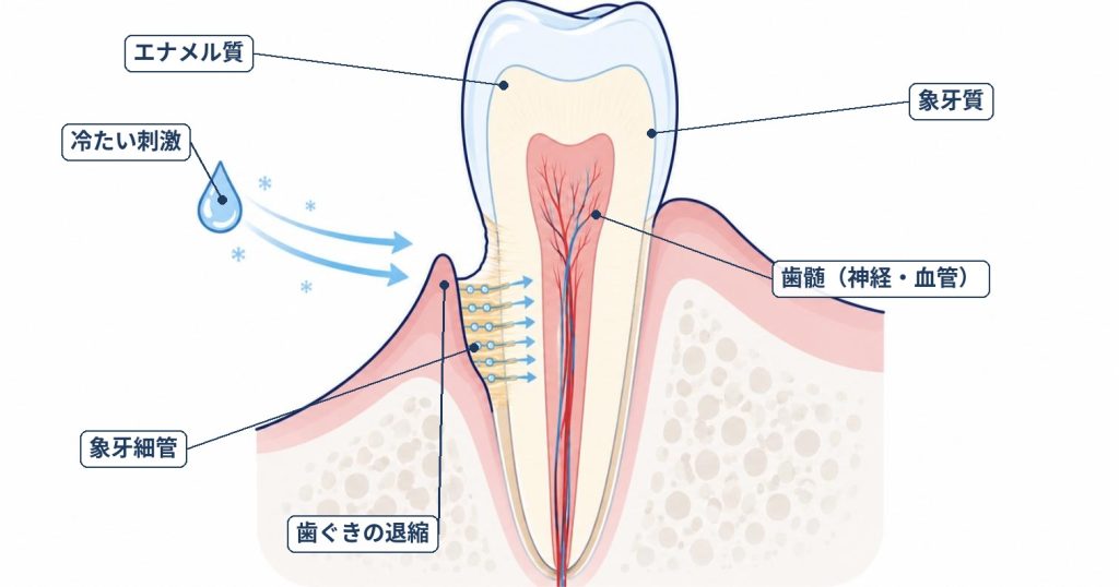 刺激で象牙細管内の組織液が動き、歯髄の神経を刺激する動水力学説の図解