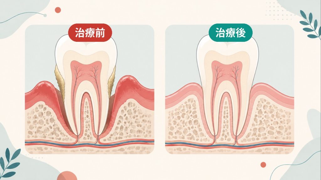 歯周治療の前と後の断面比較。治療前は歯石と炎症・深いポケット、治療後は歯ぐきが引き締まり炎症が治まる。