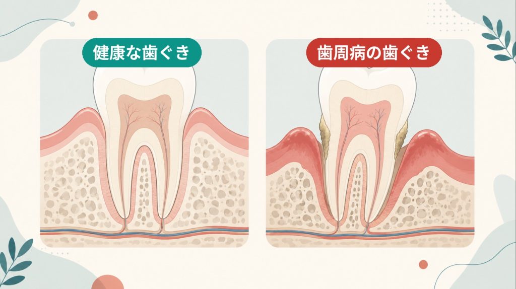 健康な歯ぐきと歯周病の歯ぐきの断面比較。歯周病では歯ぐきが下がり骨が溶け、歯石が付着している。