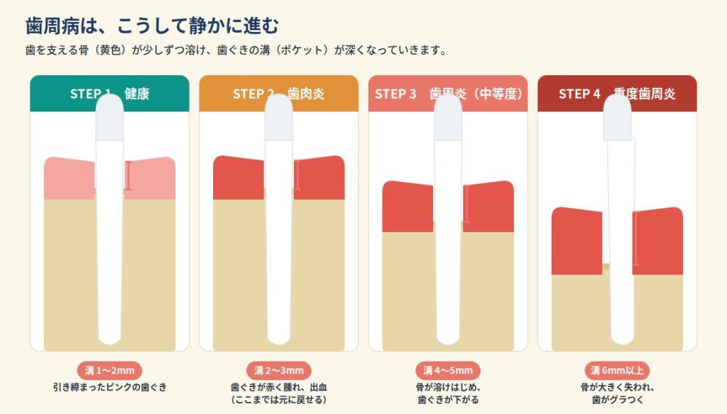 歯周病の進行4段階。健康→歯肉炎→中等度歯周炎→重度歯周炎。骨が溶けポケットが深くなる。