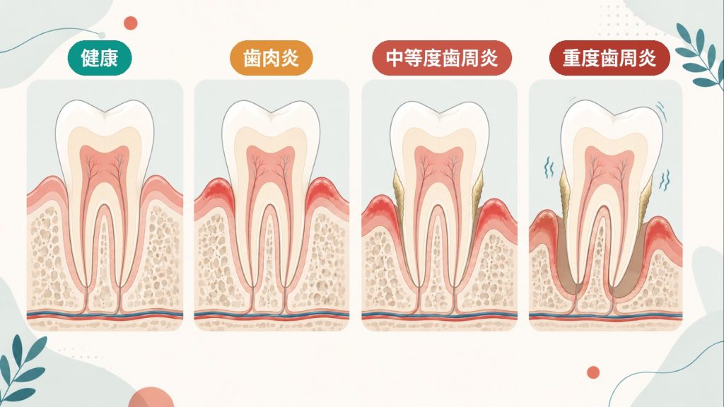 歯周病の進行4段階。健康→歯肉炎→中等度歯周炎→重度歯周炎。骨が溶けポケットが深くなる。
