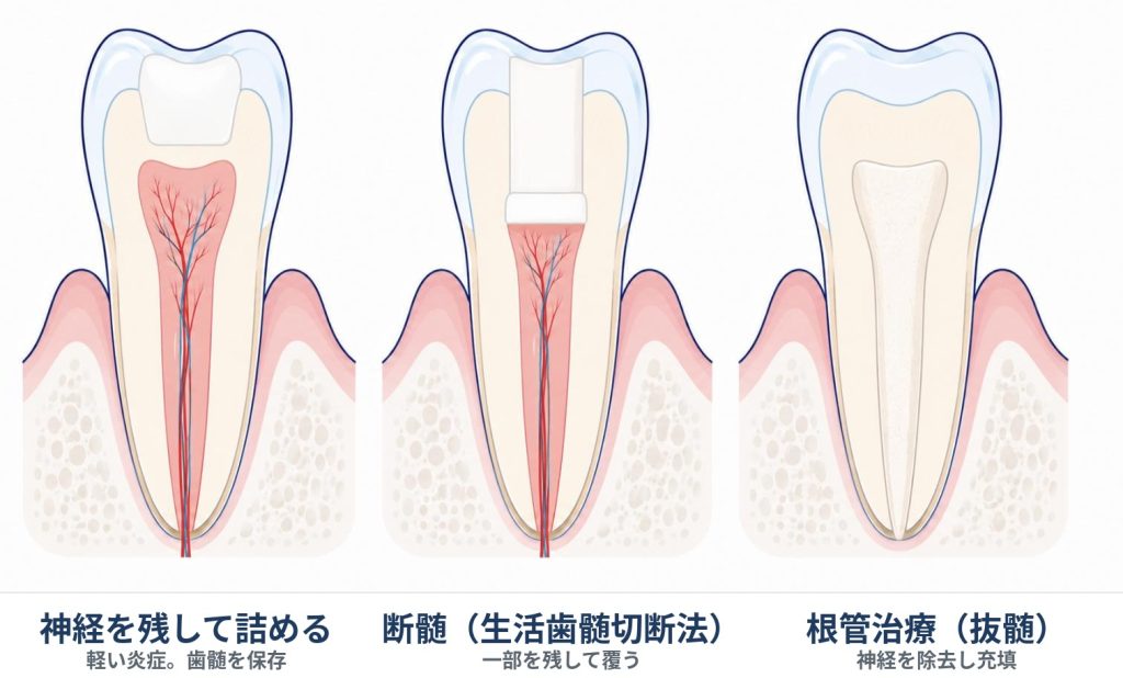 歯髄炎の治療の3つの選択肢。神経を残して詰める・断髄・根管治療を比べた歯の断面イラスト。