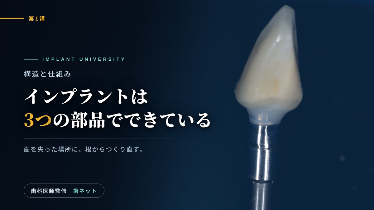 アバットメントに装着された前歯のクラウンのマクロ写真と、「インプラントは3つの部品でできている」の文字