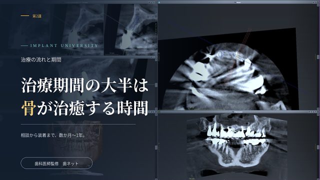 CBCTによるインプラントの治療計画画面と、「治療期間の大半は骨が治癒する時間」の文字