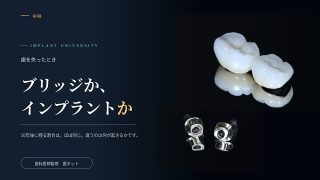 濃紺の背景に、セラミックのクラウンとインプラントのアバットメントを並べた写真。第4講「ブリッジか、インプラントか」のアイキャッチ