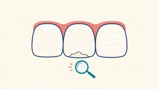 3本の前歯にそれぞれ異なるタイプの白い斑点（歯ぐき際のチョーク状、境界のはっきりしたクリーム色、全体に広がる薄い縞）が現れている様子を、虫めがねとともに描いたフラットなイラスト