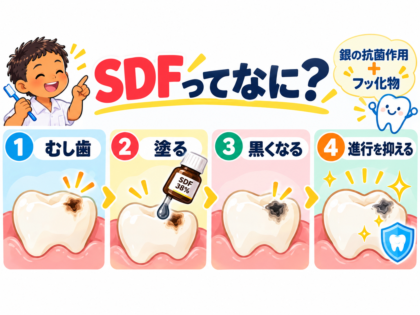 フッ化ジアンミン銀SDFをむし歯に塗布して進行を抑える仕組み