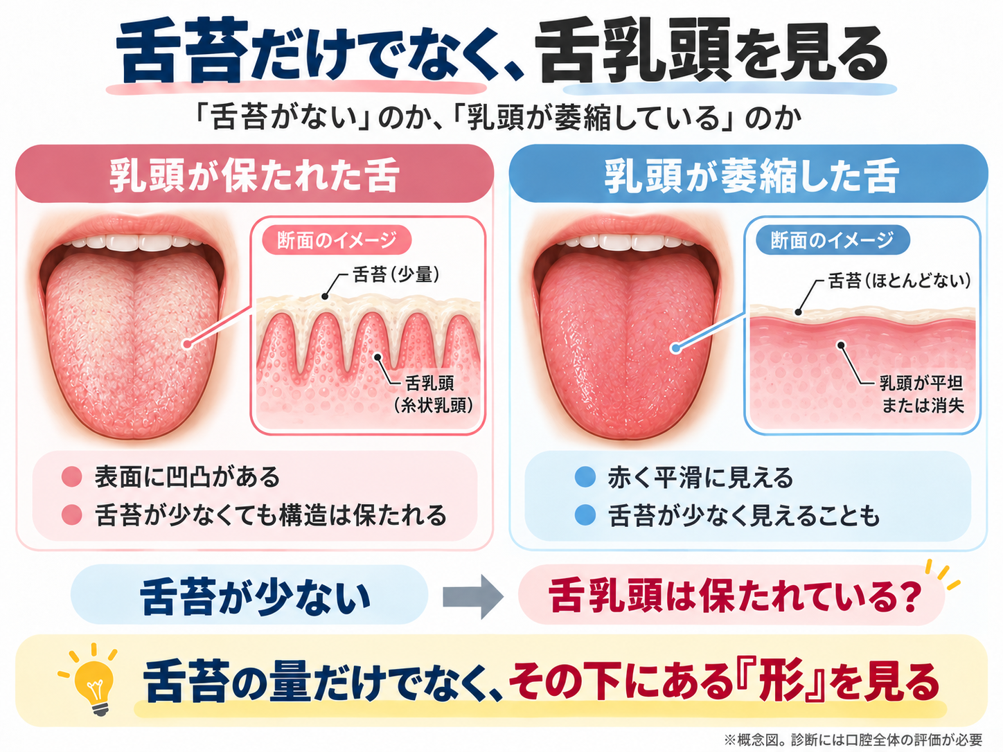 舌乳頭が保たれた舌と萎縮した舌を比較し、舌苔だけでなく形も見るべきことを示した図