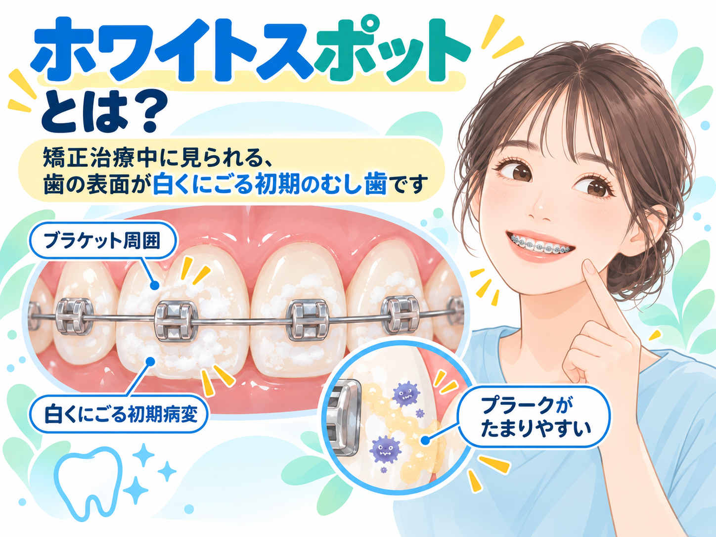 矯正中のむし歯とホワイトスポットを説明する図